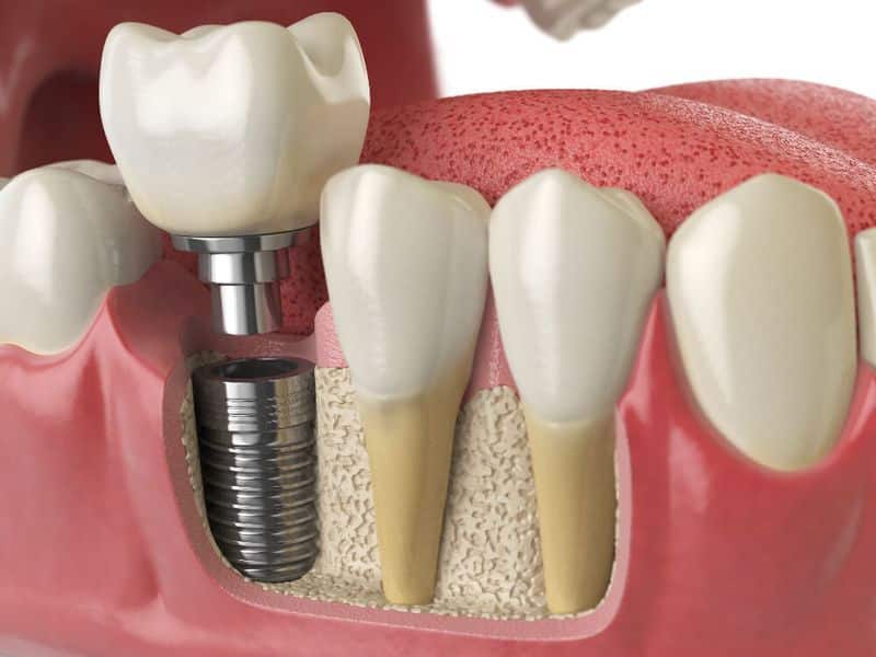 Graphic of Dental Implant being Placed in Patient Mouth